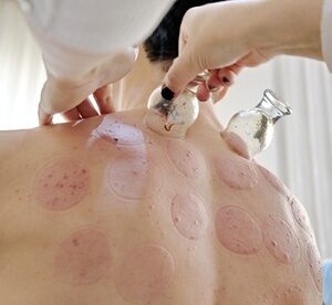 Hijama or Dry Cupping Session
